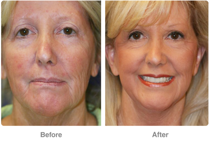 PRP Facelift Bluefern Spa